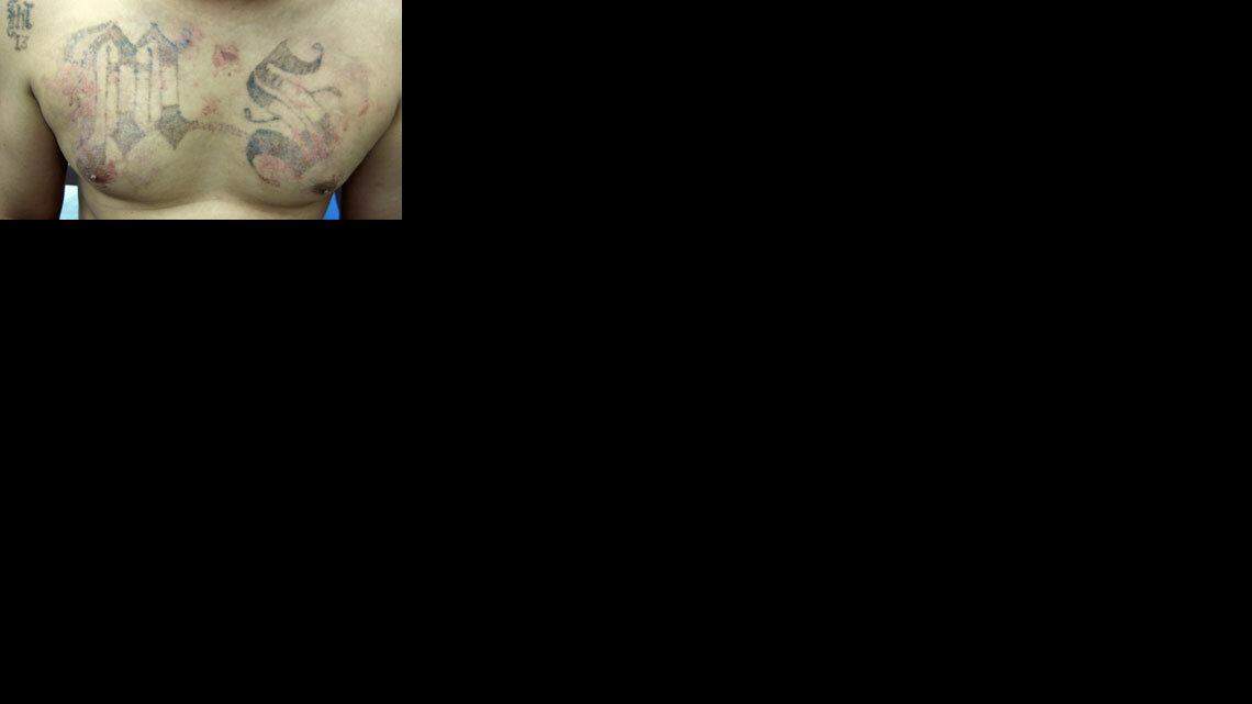 A big "MS" -- which stands for Mara Salvatrucha, the largest street gang in El Salvador -- is still visible after several laser treatments for its removal.