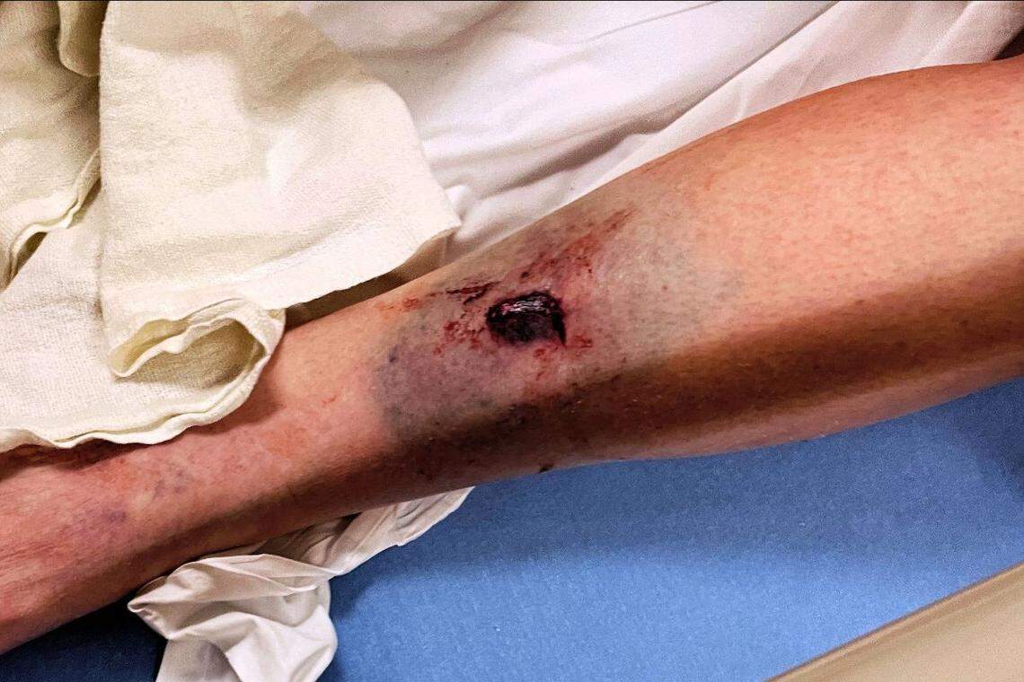 This photo taken at a hospital shows the puncture wound from the deer.