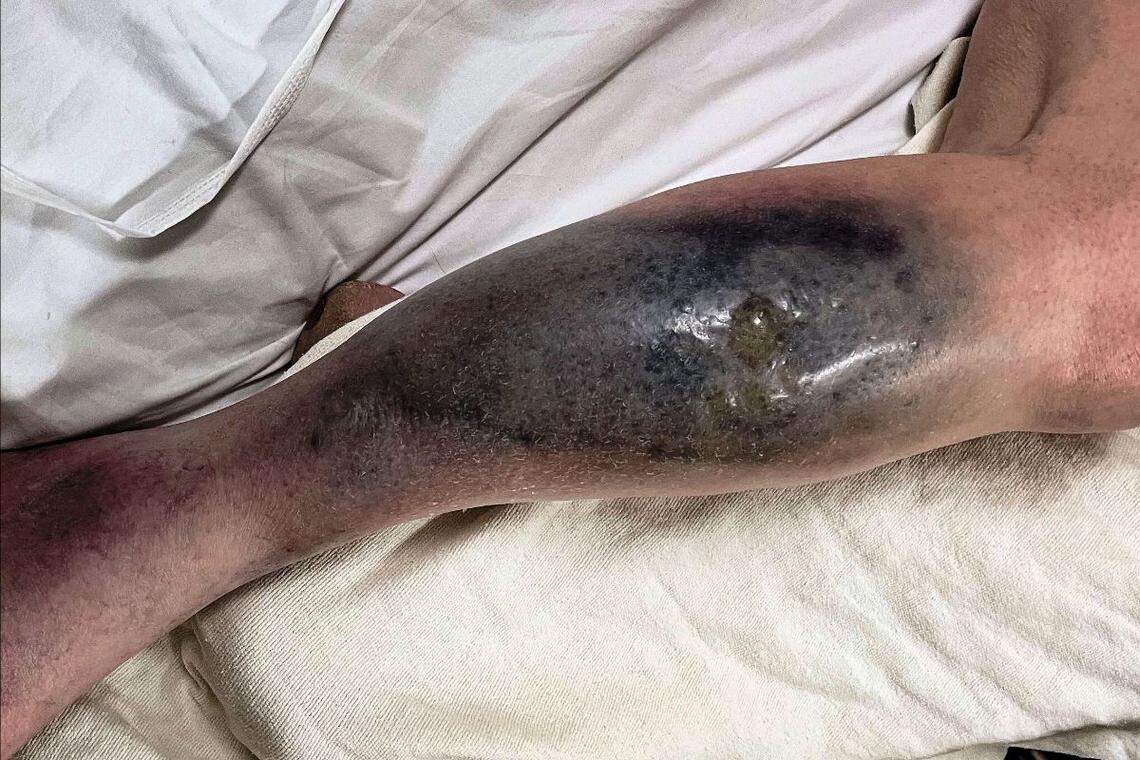 This photo shows the woman’s leg after she was gored by a deer’s antlers.