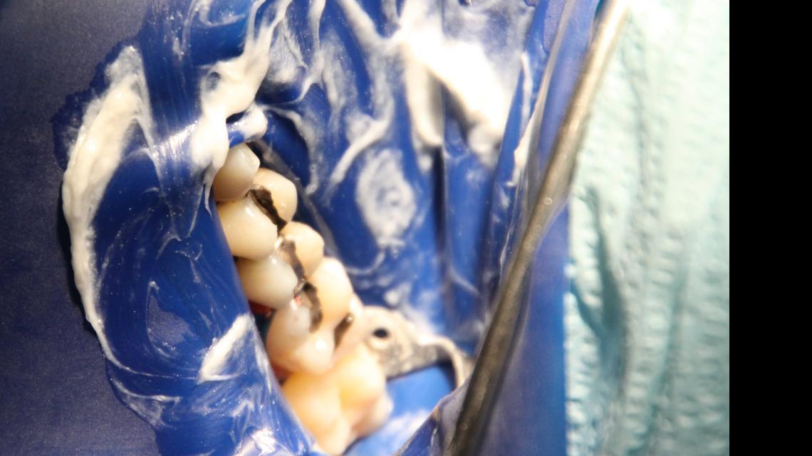 
As Dr. Blanche Grube safely performs amalgam removal, mercury/”silver-filled” teeth are exposed through a rubber dam, which is inserted into the patients mouth for protection from mercury gas and vapors emitted during the removal process. White sulfur cream on the rubber dam provides the patient further protection from mercury vapors.
