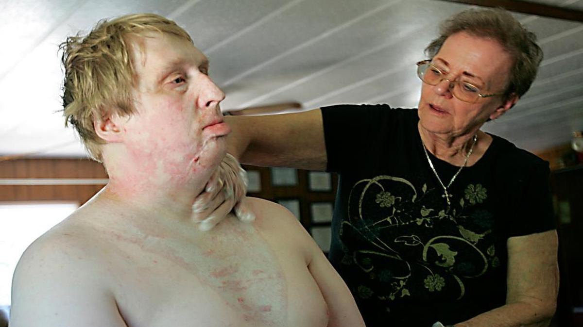 On Aug. 4, 2012, Judy Harris of Port Orchard, Wash., cares for a live-in family friend, David Hoffman, who suffered severe burns in a laundry dryer explosion. Medicaid pays Harris to provide just over two hours of care each day. But Medicaid funding for home-care services could be in jeopardy under the GOP health care bill moving through Congress.